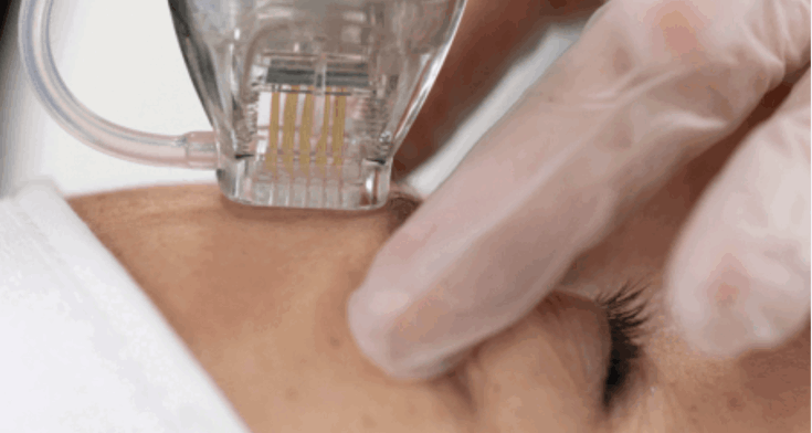 RF Needling close-up